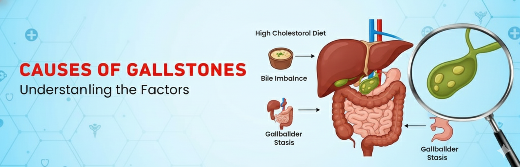 Causes of Gallstones in Hindi